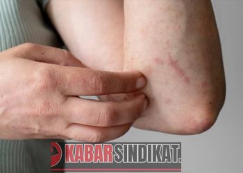 Wabah Campak dan Malaria di Pohuwato Jadi Sorotan, Tantangan Terbesar: Penolakan Imunisasi