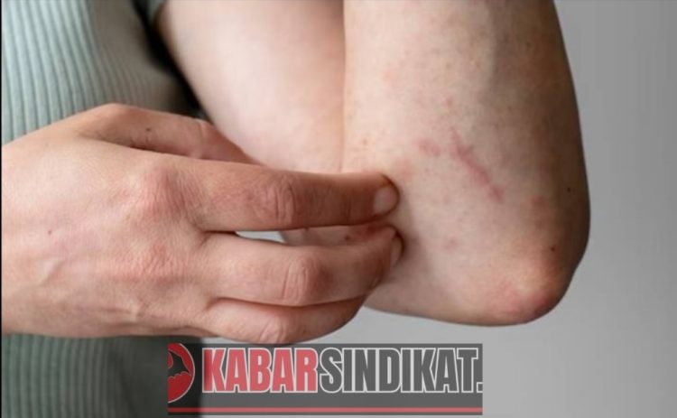 Wabah Campak dan Malaria di Pohuwato Jadi Sorotan, Tantangan Terbesar: Penolakan Imunisasi
